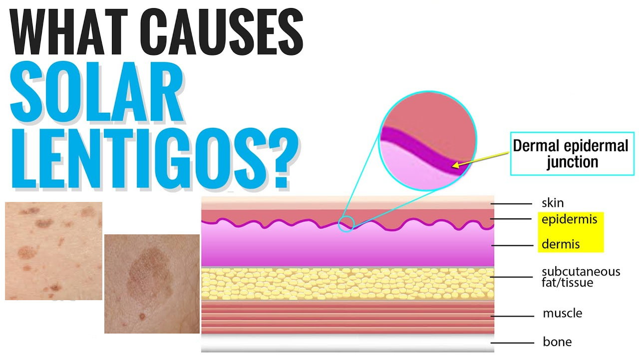 孚美达“氟轻松氢醌维A酸乳膏”能用于老年斑治疗吗？